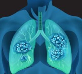 terapia-biologica-en-cancer-de-pulmon